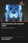 Liposarcoma dei tessuti molli